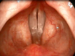 Laringostroboscopia con assetto glottico regolare