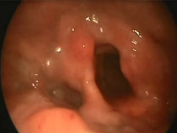 Ariepiglottica