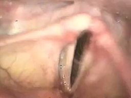Fonochirurgia nella paralisi cordale